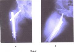 Способ лечения переломов проксимального отдела бедра в условиях остеопороза (патент 2473317)