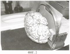 Способ комплексной посмертной патоморфологической диагностики заболеваний головного мозга (патент 2355311)