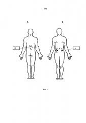 Устройство для неинвазивной электрической стимуляции спинного мозга (патент 2627359)