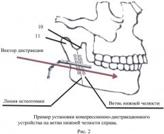 Способ для расширения ветви нижней челюсти и компрессионно-дистракционное устройство для его осуществления (патент 2599370)