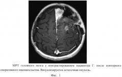 Способ термохимиолучевого лечения злокачественных глиом головного мозга (патент 2567836)