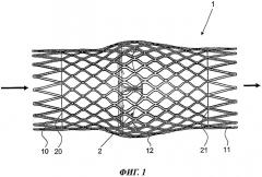 Стент, снабженный клапаном сосуда (патент 2469681)