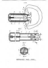 Устройство для фиксации костных отломков (патент 1127582)