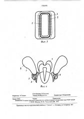 Слюноизолятор (патент 1736470)