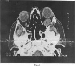 Способ удаления ретробульбарной опухоли орбиты (патент 2363393)