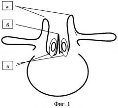 Способ формирования задней стенки позвоночного канала при спинальной дизрафии (патент 2497472)