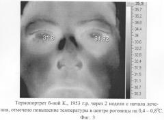 Способ диагностики ишемии зрительного нерва (патент 2299672)