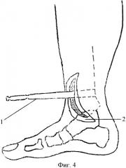 Способ артродеза голеностопного сустава (патент 2328996)