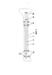 Устройство для интрамедуллярного остеосинтеза большеберцовой кости при переломах, предпочтительно, у детей (патент 2586595)