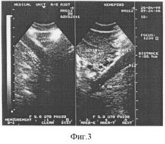 Способ диагностики варикозного расширения вен малого таза у женщин (патент 2295291)