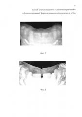Способ лечения пациентов с декомпенсированной и субкомпенсированной формами повышенной стираемости зубов (варианты) (патент 2615121)