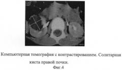 Способ дифференциальной диагностики чашечковых дивертикулов и солитарных кист почек у детей (патент 2411910)