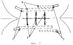 Способ оперативного лечения нагноившегося эпителиального копчикового хода (патент 2277864)