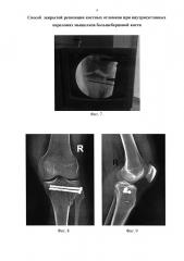 Способ закрытой репозиции костных отломков при внутрисуставных переломах мыщелков большеберцовой кости (патент 2625651)