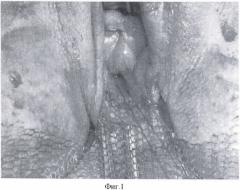 Способ хирургического лечения опущения и/или выпадения стенок влагалища у женщин после экстирпации матки (патент 2476175)
