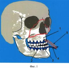 Устройство для лечения переломов средней зоны лица и способ его применения (патент 2546930)
