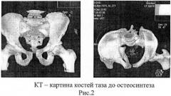 Способ чрескостного остеосинтеза односторонних нестабильных повреждений таза (патент 2457805)