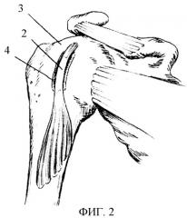 Способ хирургического лечения привычного вывиха плеча (патент 2392895)