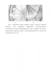 Способ комплексной оценки эффективности полихимиотерапии у больных с рецидивной лимфомой ходжкина (патент 2623143)