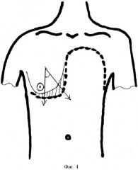 Способ лечения больных с обширными дефектами передней грудной стенки (патент 2528965)