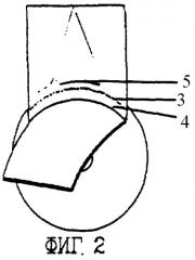 Способ хирургического лечения закрытоугольной глаукомы (патент 2260406)