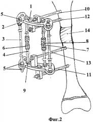 Устройство для удлинения бедренной кости с одновременным восстановлением биомеханической оси конечности (патент 2452419)