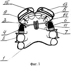 Аппарат для лечения гнатической формы мезиальной окклюзии у подростков (патент 2547794)