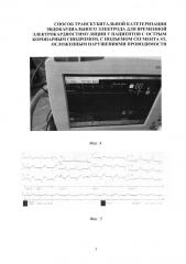 Способ катетеризации сердца для установки эндокардиального электрода для временной электрокардиостимуляции у пациентов с острым коронарным синдромом, с подъемом сегмента st, осложенным нарушениями проводимости (варианты) (патент 2594243)