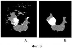Сегментация тканей человека на компьютерном изображении (патент 2654199)
