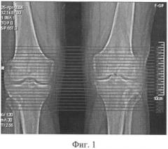 Способ определения степени изменения губчатой кости при деформирующем артрозе коленного сустава (патент 2487669)