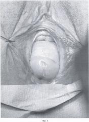 Способ хирургического лечения опущения передней стенки влагалища у женщин с сохраненной шейкой матки (патент 2476176)