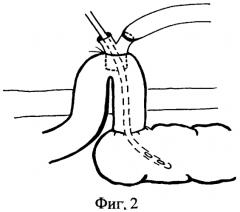 Способ декомпрессии толстой кишки при обтурационной непроходимости (патент 2549489)