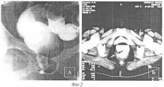 Способ лучевой диагностики тазовых органов (патент 2359613)