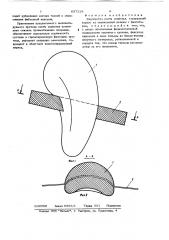 Эндопротез кости запястья (патент 637118)
