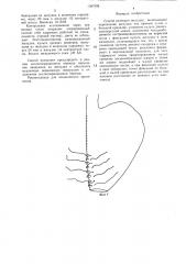 Способ резекции желудка (патент 1387995)