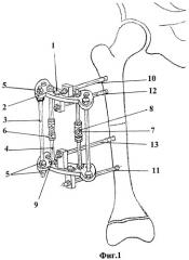 Устройство для удлинения бедренной кости с одновременным восстановлением биомеханической оси конечности (патент 2452419)