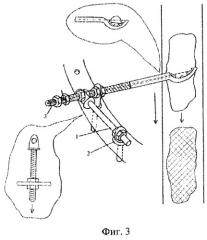 Устройство для репозиции и фиксации костных осколков (патент 2284784)