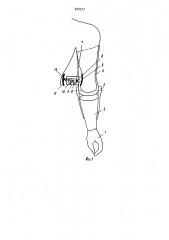 Протез плеча на культю с булавовидным утолщением (его варианты) (патент 950373)