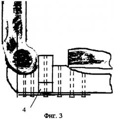 Способ лечения застарелого перелома-вывиха в локтевом суставе (патент 2289338)