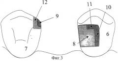 Способ замещения единичного отсутствующего зуба волоконно-композитным несъемным адгезивным мостовидным протезом (патент 2320292)