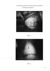 Способ хирургического лечения грыж в сочетании с абдоминопластикой (патент 2658161)