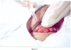 Способ зондирования протока мейбомиевой железы (патент 2375018)