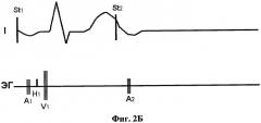 Способ оценки электрических свойств атриовентрикулярного соединения (патент 2300311)