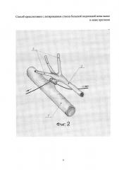 Способ кроссэктомии с лигированием ствола большой подкожной вены выше и ниже притоков (патент 2607919)