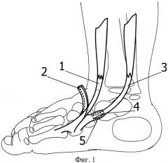 Способ хирургической коррекции врожденной плосковальгусной деформации стопы у детей (патент 2408314)
