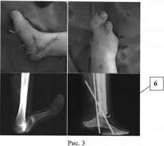 Способ устранения пяточной деформации однолучевой стопы при продольной эктромелии костей голени (патент 2539628)