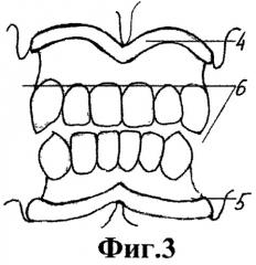 Ортодонтический аппарат (патент 2491896)