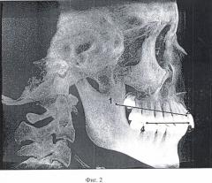 Способ нахождения анатомической плоскости, являющейся параллельной плоскости окклюзии (патент 2471452)
