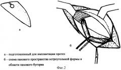 Способ герниопластики при паховых грыжах (патент 2338467)