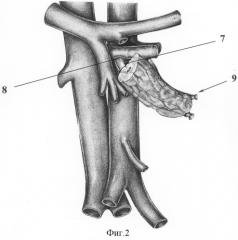 Способ сегментарной трансплантации поджелудочной железы (патент 2311880)